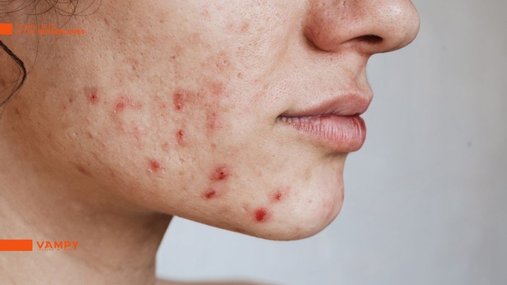 پوست دهیدراته که دچار پوسته پوسته شدن و جوش زدگی شده