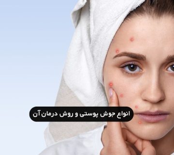 انواع جوش صورت و راه درمان آن