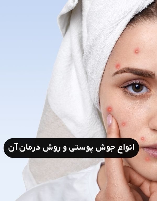 انواع جوش صورت و راه درمان آن