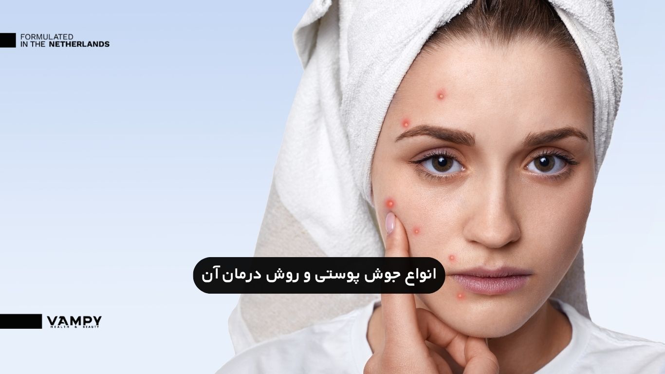 انواع جوش صورت و راه درمان آن