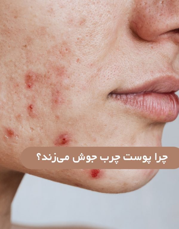پوست چرب چرا جوش می زند؟