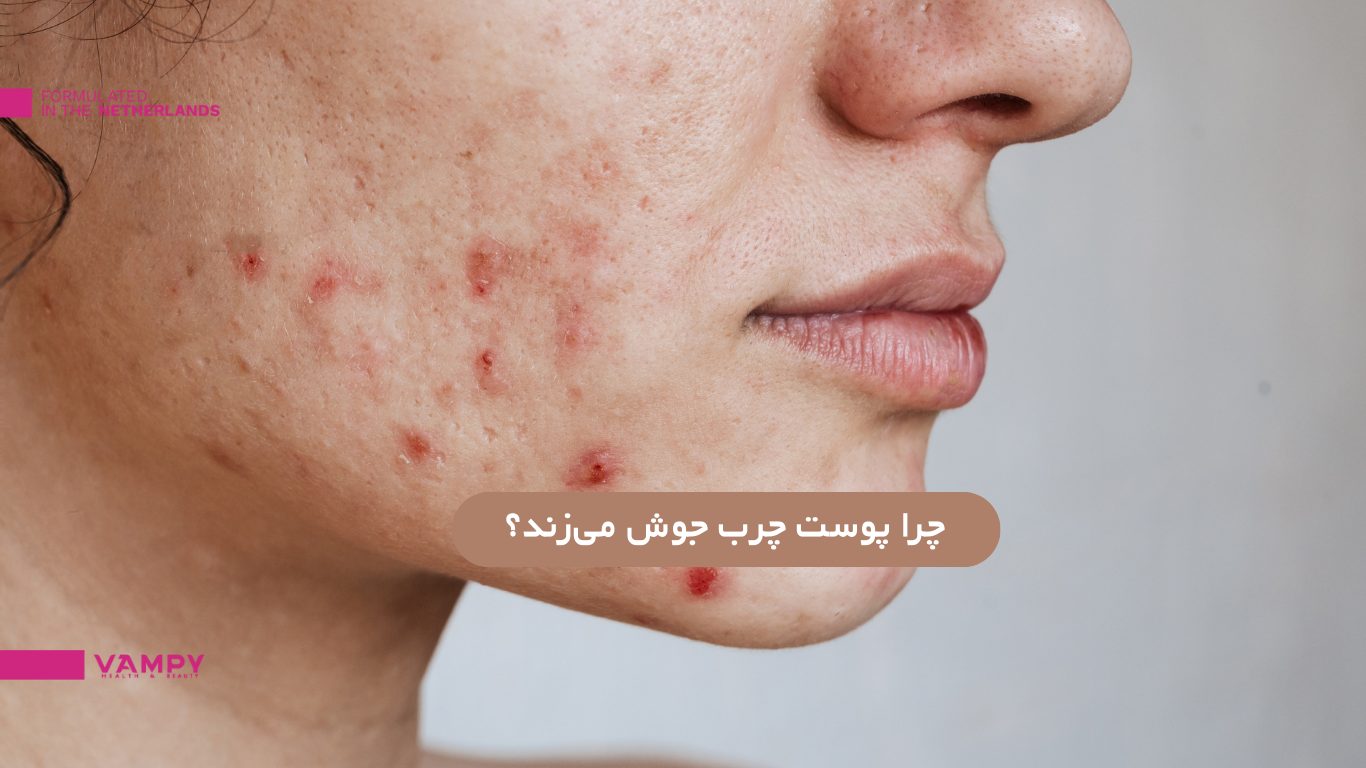 پوست چرب چرا جوش می زند؟